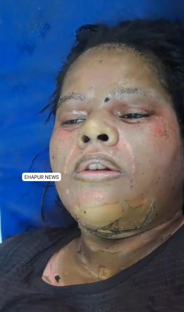 महिला पर ज्वलनशील पदार्थ डालकर आग लगाने के मामले में मुकदमा दर्ज